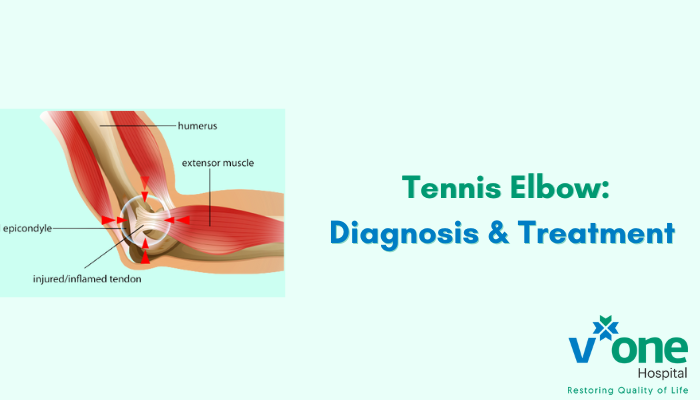 Tennis Elbow Treatment Methods with Diagnosis by V-One Hospital Indore
